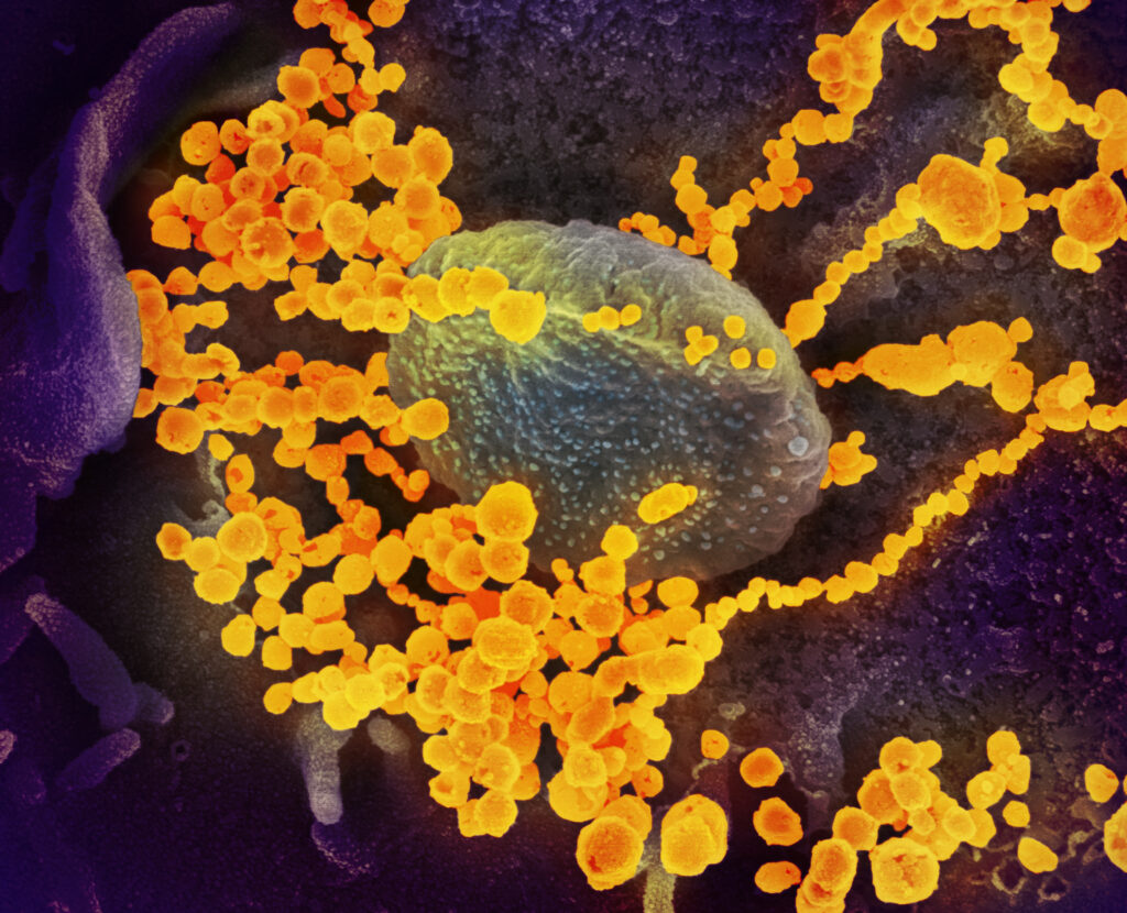 Částice viru SARS-CoV-2 opouští napadenou buňku