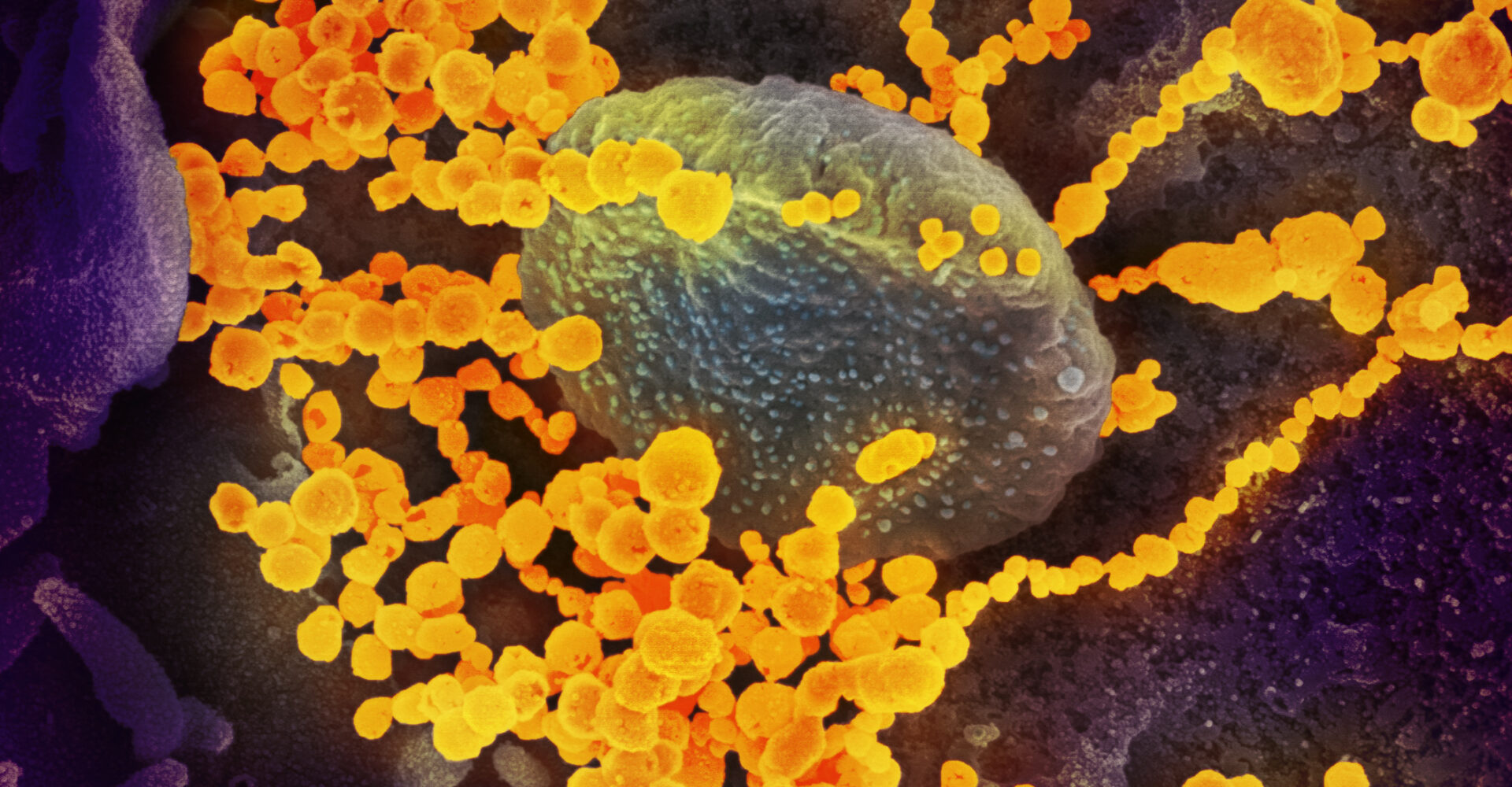 Částice viru SARS-CoV-2 opouští napadenou buňku