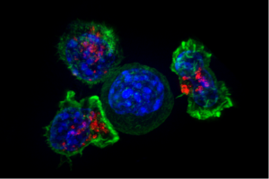 Skupina "zabijáckých" CD8+ T-lymfocytů útočé na rakovinovou buňku (uprostřed)